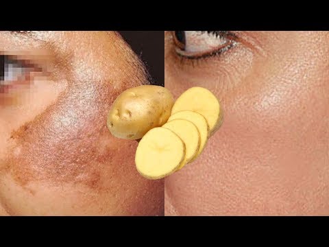 How To Use Potato To Treat Pigmentation, Dark Spots, Acne Scars Easily At Home | Home Remedies