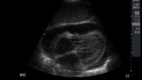 Subcostal with large effusion and tamponade physiology