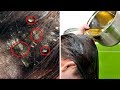 3 Home Remedies to Get Rid of Dandruff Naturally