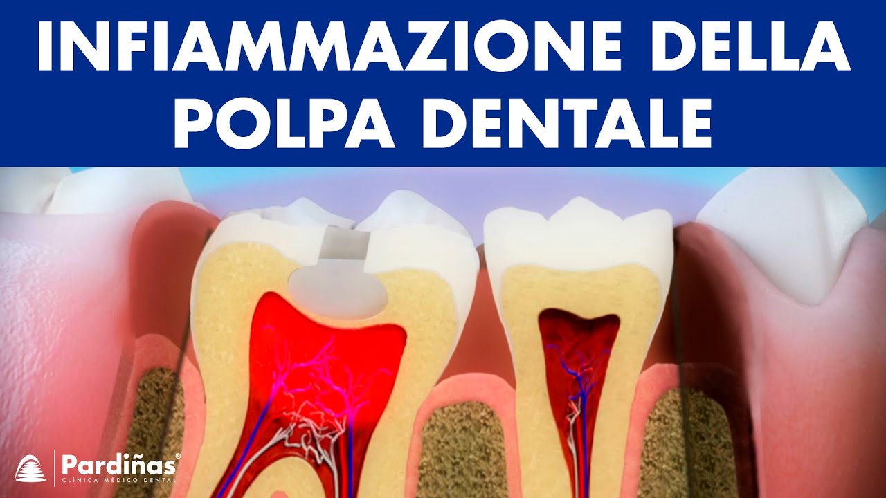 Pulpite - Infiammazione della polpa dentale ©