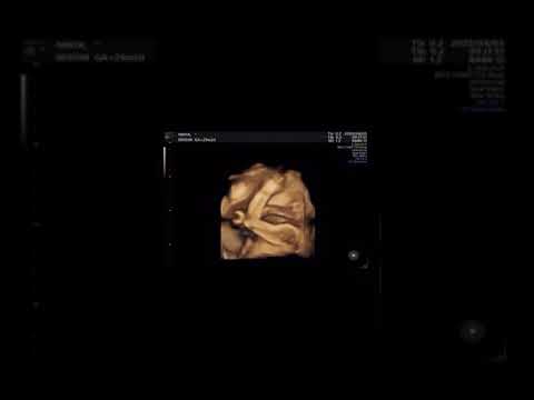 29週2日目　エコー動画