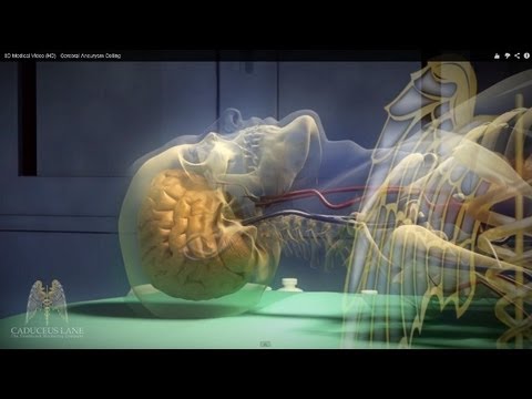 3D Medical Video (HD) - Cerebral Aneurysm Coiling