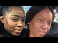 How I Got Rid Of Severe Acne using only 4 PRODUCTS | "They Told Me I Will Be SUICIDAL"