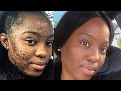 How I Got Rid Of Severe Acne using only 4 PRODUCTS | "They Told Me I Will Be SUICIDAL"