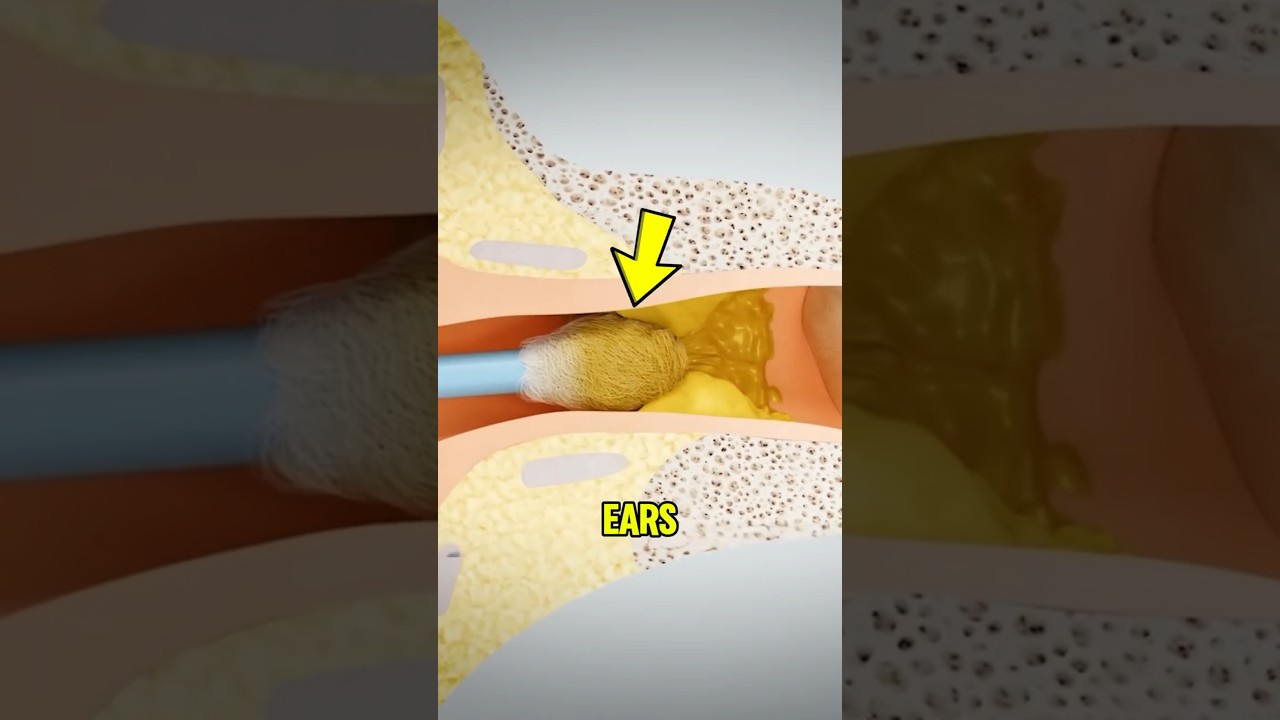 Ever Wonder Why Q Tips Make Earwax Worse?