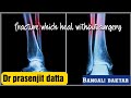 5 fractures which heal without surgery bangali daktar dr prasenjit dattafracture  no surgery