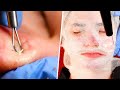 Acne Facial | Blackhead Extractions