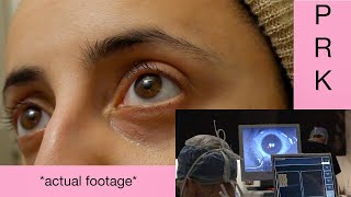 My PRK Eye Surgery and Recovery Experience (2019)