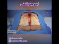 انیمیشن جراحی زیبایی شکم