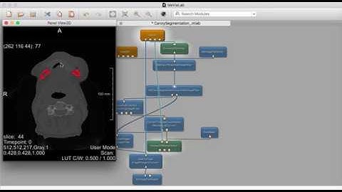 MeVisLab Canny Level Set Image Filter Tutorial Video for Mandibular / Lower Jawbone Segmentation