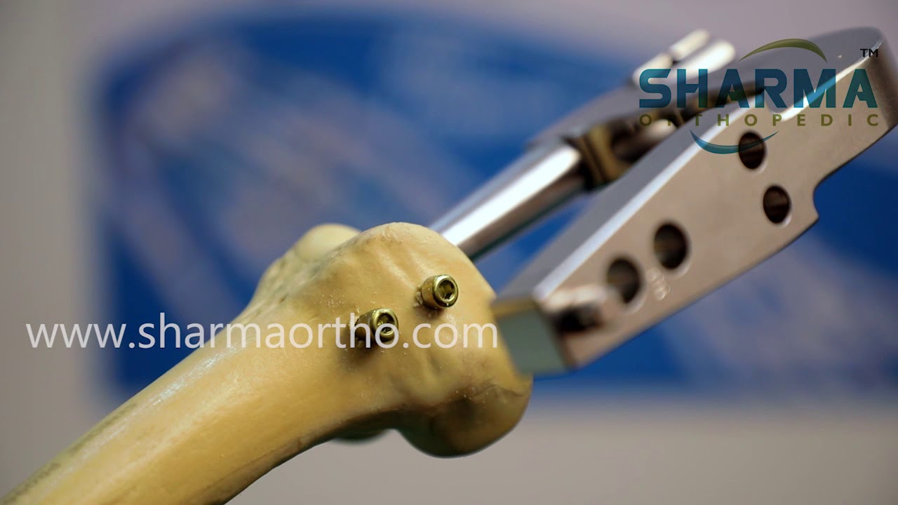 Distal Femoral Nails at Best Price in Mangalore | ASIAN SURGICAL INSTRUMENT