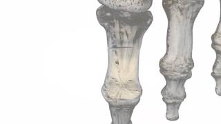 STAPiX™ Superelastic Nitinol Staple Fixation