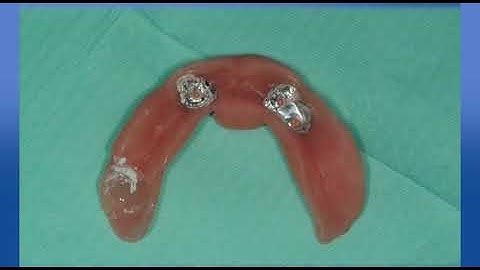 Rhein83 Roots Overdentures PIVOTS ENG