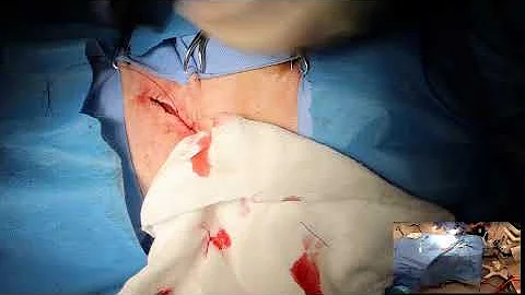 Large salivary gland tumour removal in a dog