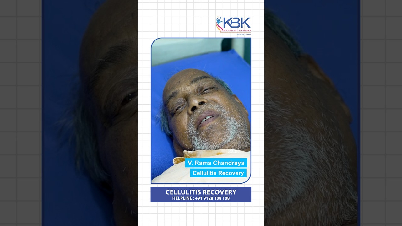 Cellulitis Recovery at KBK Hospitals | Patient Testimonial | Success Story