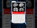 اضطراب في الدماغ يتفاقم مع مرور الوقت