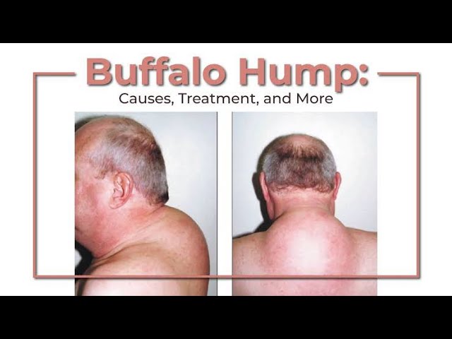 Start Feeling Better By Getting Rid Of Your Buffalo Hump - Pure