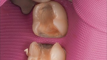 Quadrant of 3D printed fillings!