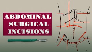 Basics Of Abdominal Incisions Commonly Used Incisions For Abdominal Surgeries