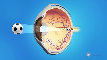 Posterior Capsule Opacification (PCO) - Also known as Secondary Cataracts or Cataract Scar Tissue