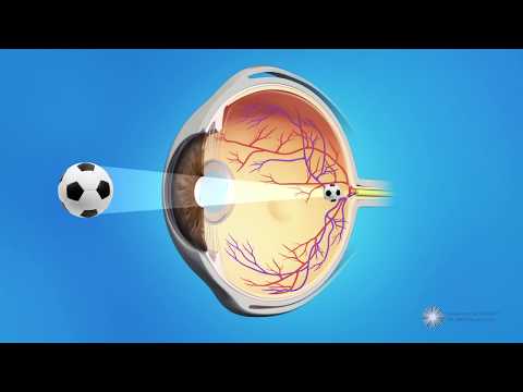 Posterior Capsule Opacification (PCO) - Also known as Secondary Cataracts or Cataract Scar Tissue