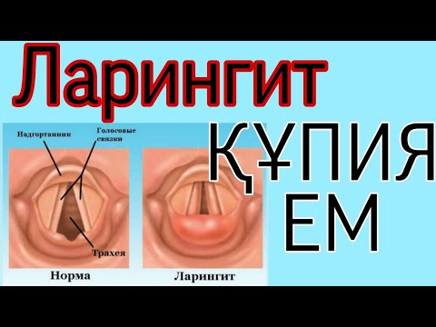 ЛАРИНГИТТІ ЕМДЕУДІҢ құпия тәсілі.Ларингит деген не