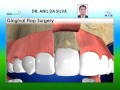 Gingival Flap Surgery