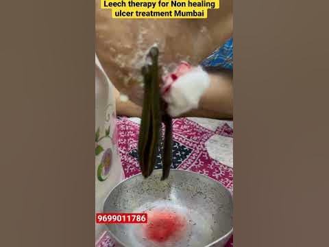 How do you treat a non healing ulcer? #leechtherapy#leech#ulcer#