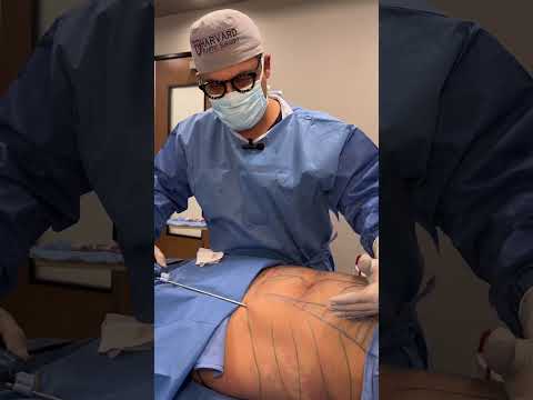 Video: Puas liposuction minimally invasive?