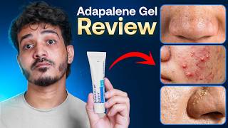Can This Cream Really Clear Acne & Blackheads? 😳✨
