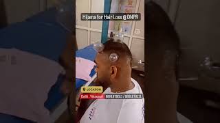 Hijama Therapy for Hair Growth in Delhi/ 9891878611 Call Now