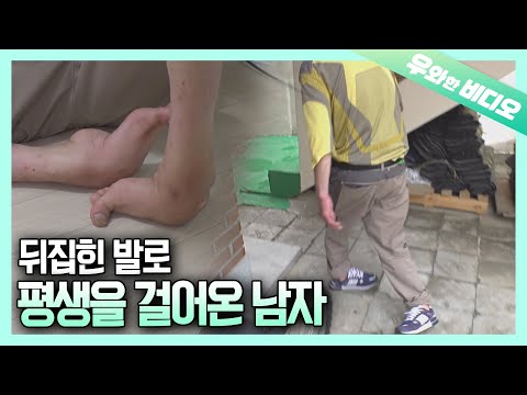 55년 동안 발등으로 걸어야 했던 남자의 사연 | A <strong>Man</strong> Who Had to Walk on <strong>Top</strong> of His Feet for 55 Years