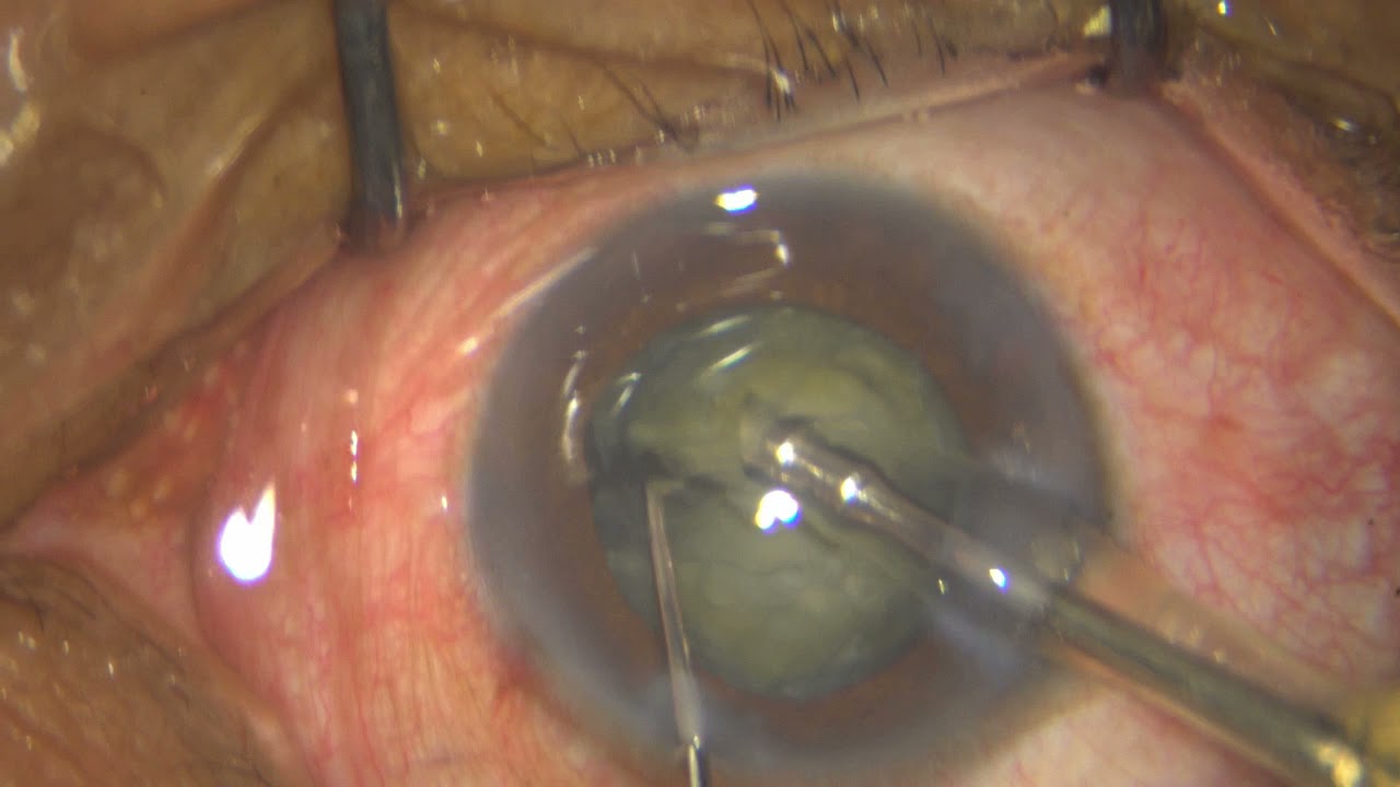 Phaco using direct vertical chops in a routine case with Grade 3 sclerosis and dense PSC