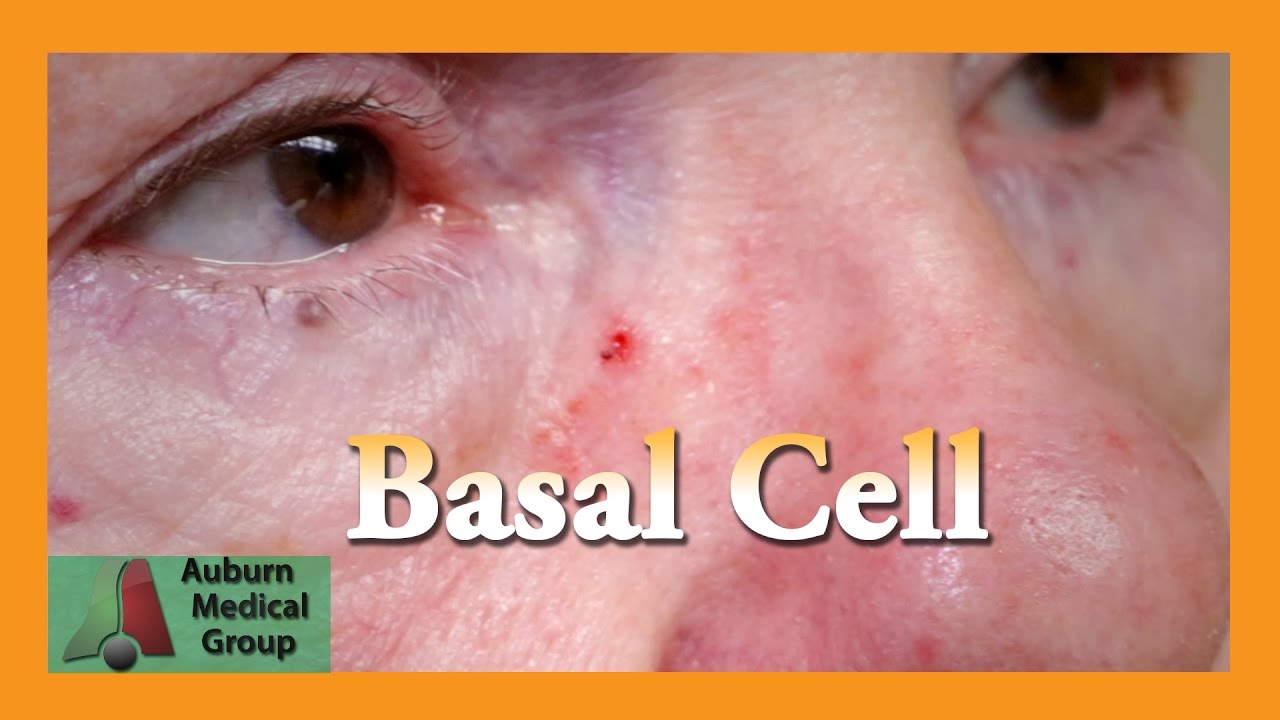 Basal Cell Carcinoma Behind Ear