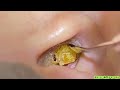 ASMR:やさしく耳をお掃除、心地よい耳そうじ音