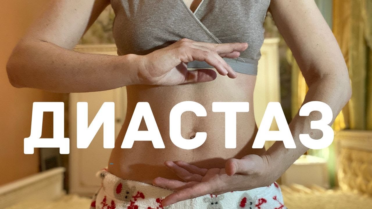 Как убрать диастаз после родов - YouTube