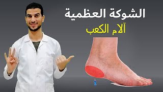 كيف تتخلص من الشوكة العظمية والم كعب القدم في 3 ايام فقط ؟! علاج الشوكة العظمية والام كعب القدم