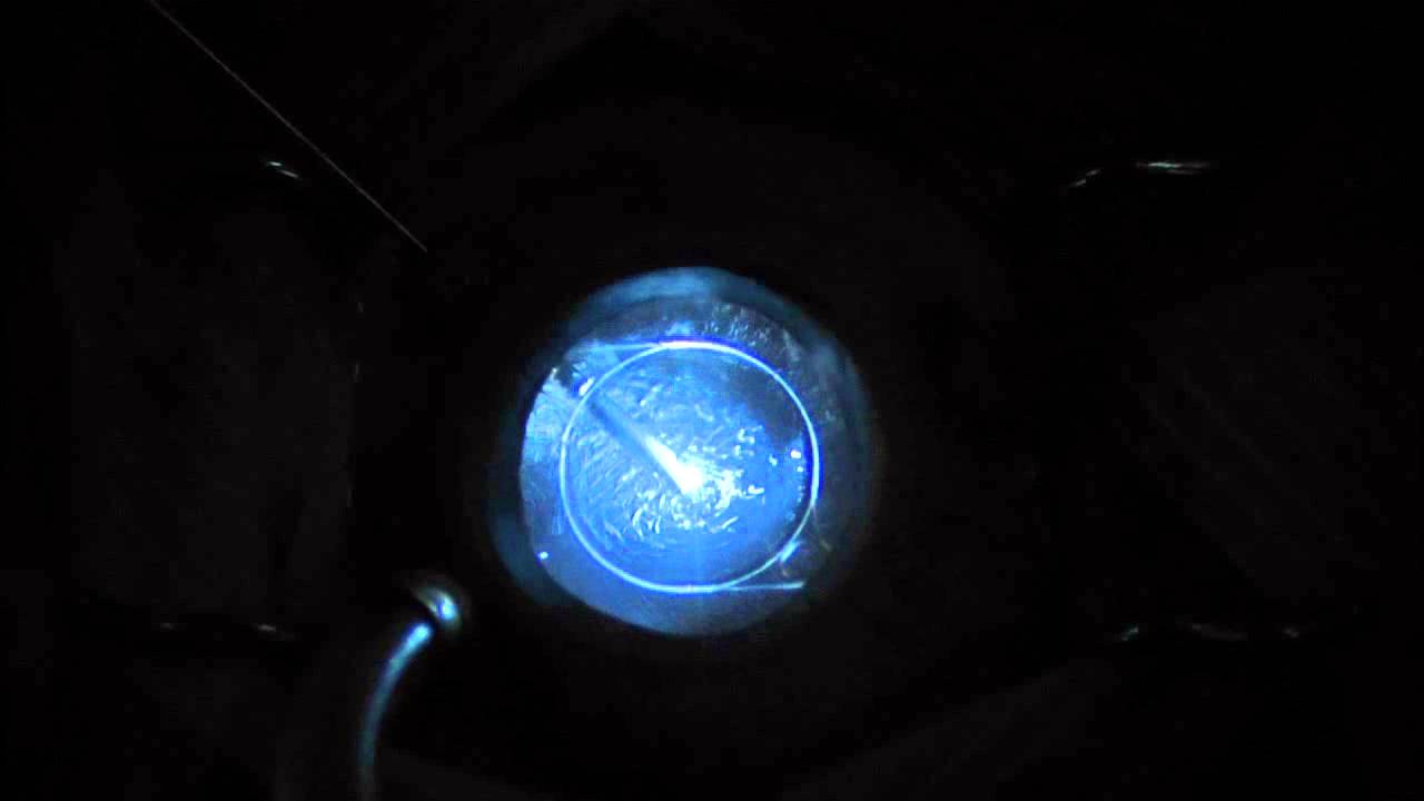 diabetes por hialosis de asteroides