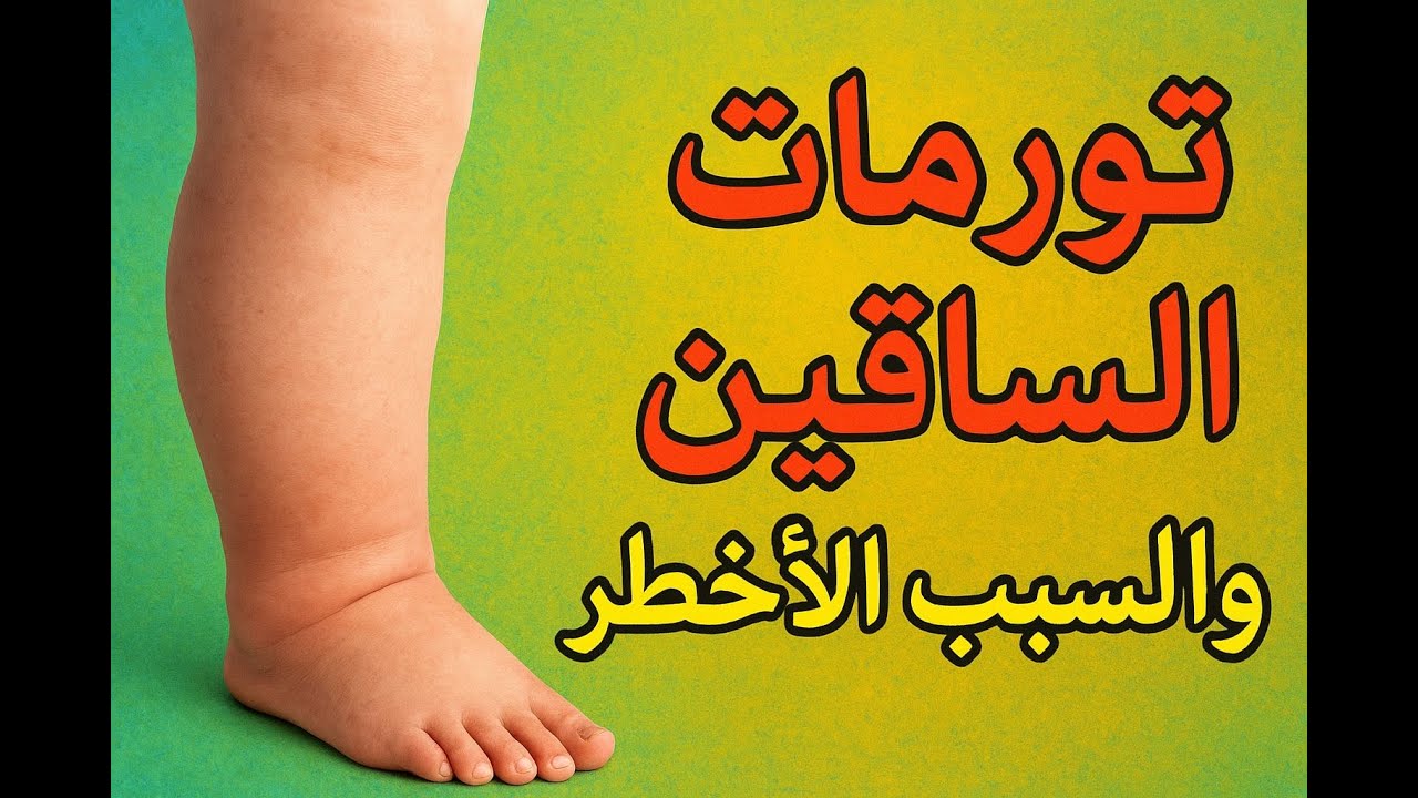تورم ساق او الساقين  ما الاسباب وما هو السبب الاخطر وكيفية التعامل