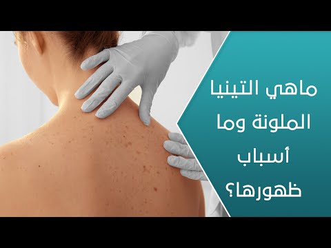 ماهي التينيا الملونة وما أسباب ظهورها العيادة
