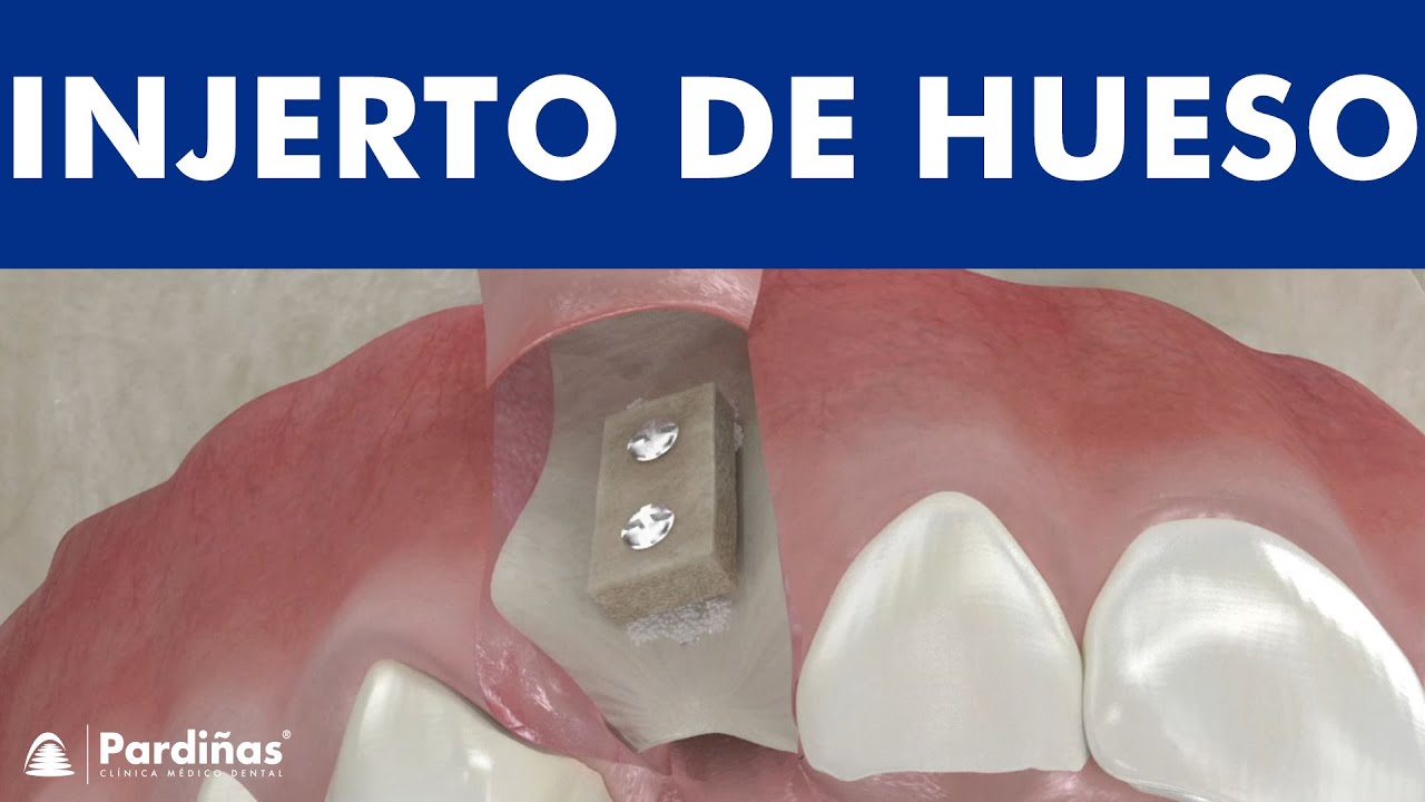Injerto de hueso dental en bloque © YouTube