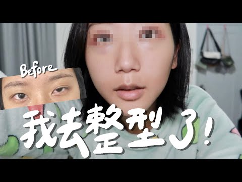 我是逼不得已的...割雙眼皮＋提眼瞼肌手術，兩個月全記錄！｜大小眼 眼皮下垂 提眼肌無力｜林宣 Xuan Lin