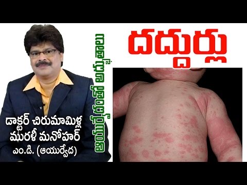 urticaria-|-hives|-దద్దుర్లు-|-prof.-dr.-murali-manohar-chirumamilla,-m.d.-(ayurveda)