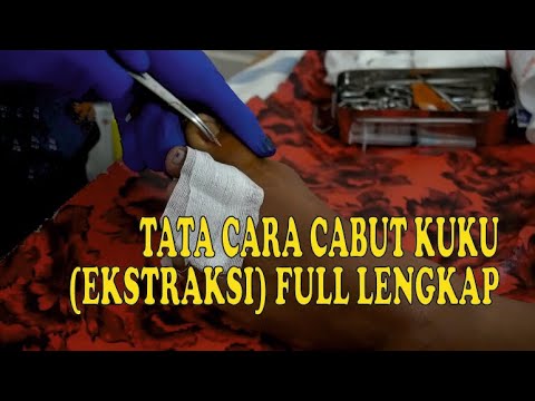 Ekstraksi (Cabut) Kuku Sederhana dan Nyaman Tanpa Rasa Sakit (Cantengan). 