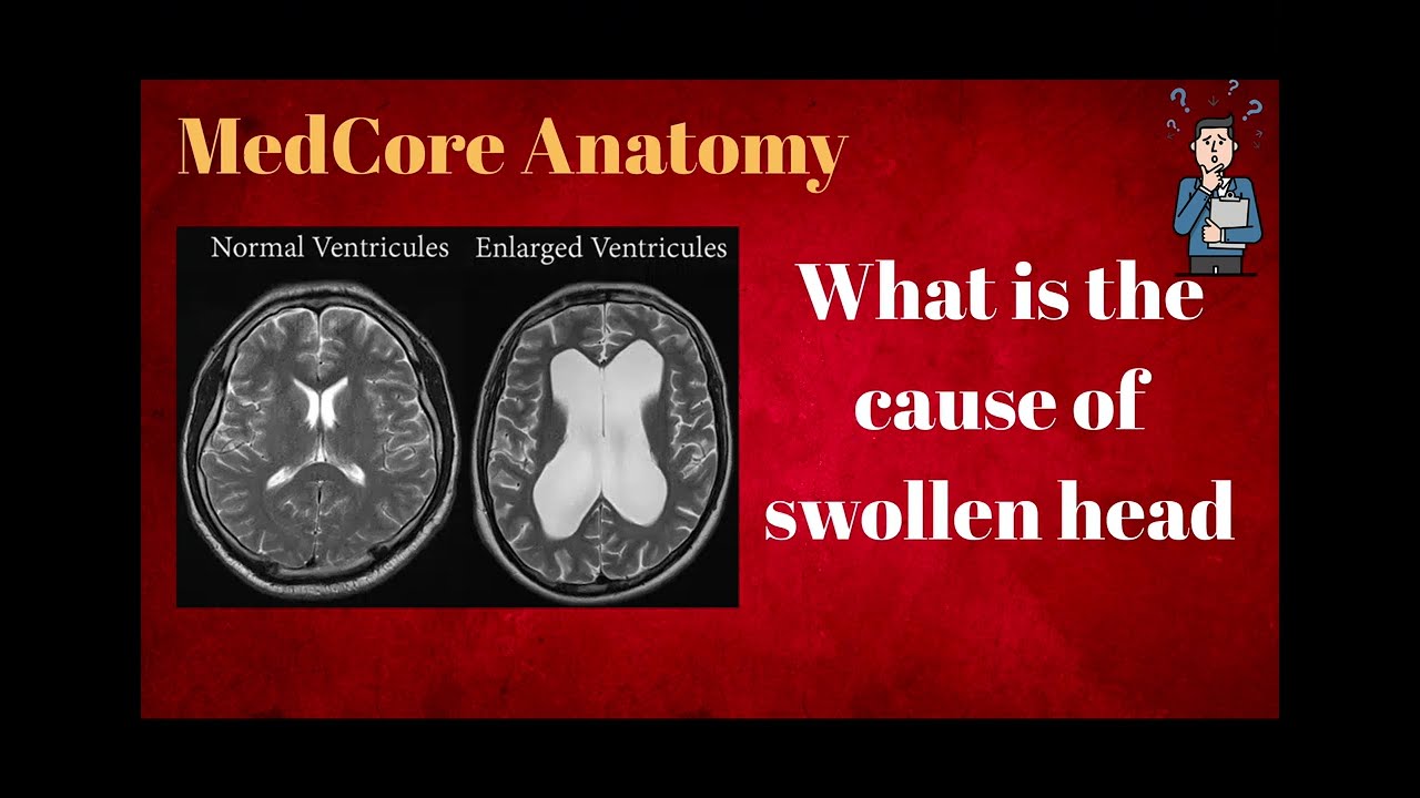 Communicating hydrocephalus 