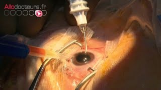 La chirurgie de la cataracte - Allô Docteurs