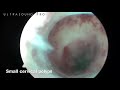 Hysteroscopy. Cervical polyps removal.  Гистероскопия. Удаление полипов шейки матки.