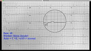 EKG of the Week #5
