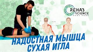 Работа с надостной мышей методом сухой иглы