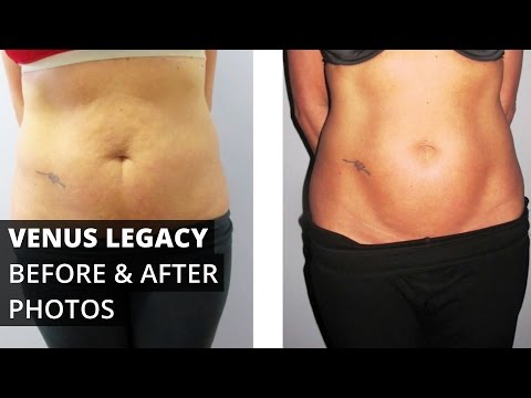 Venus Legacy™ Before & After Photos